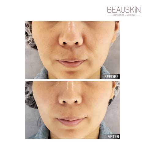 逆時針|逆時針 PROFHILO — BEAUSKIN Medical